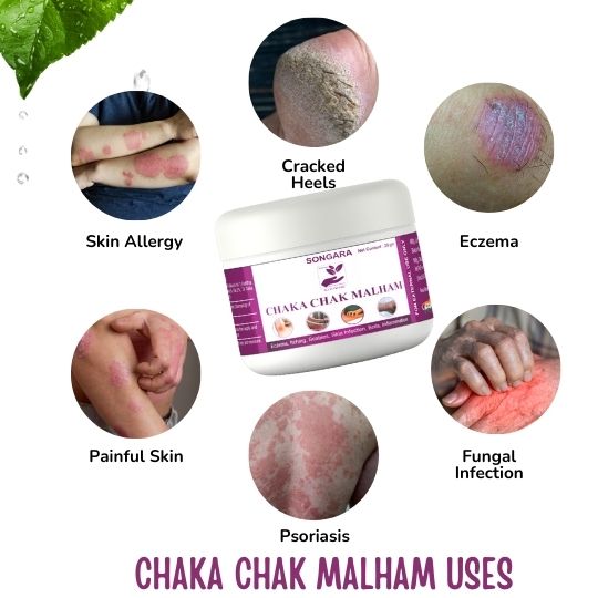 Chaka Chak Malham | Ayurvedic Ointment for Ringworm, itching, Eczema & Fungal Infection, All Type Skin, 20 gm (1 pc)